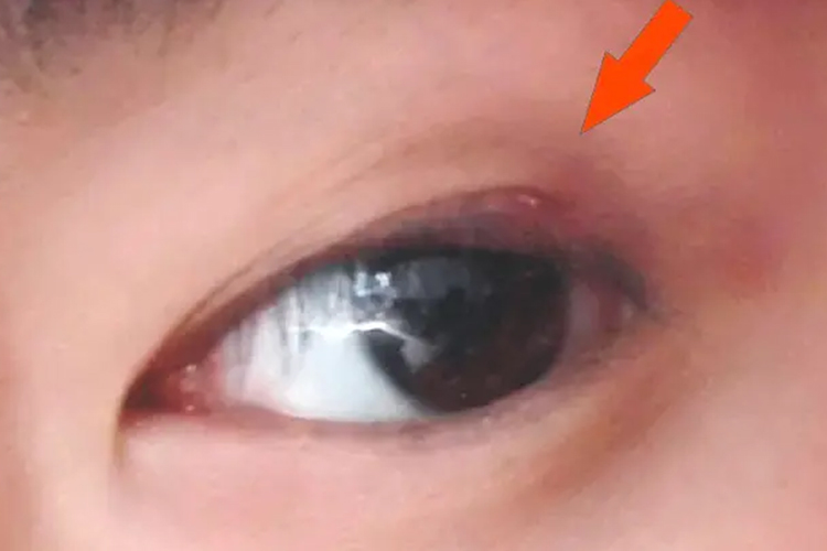 麦粒肿已长出肉芽图