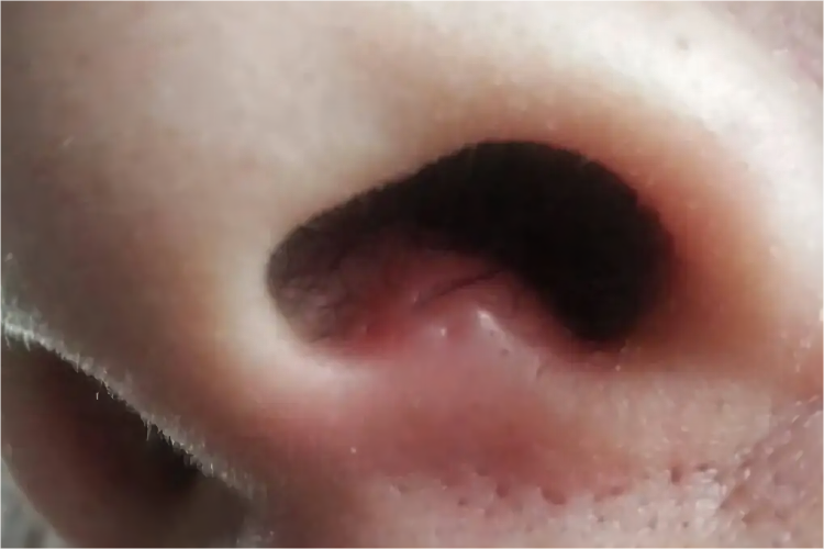 鼻小柱毛囊炎图 鼻小柱毛囊炎图