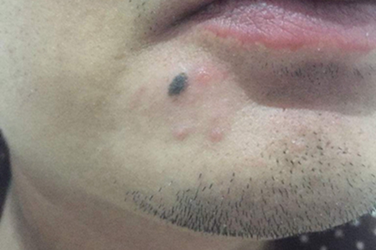 恶性黑色素瘤下巴黑斑图