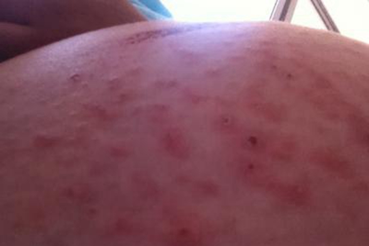 妊娠多形疹症状图 妊娠多形疹症状图