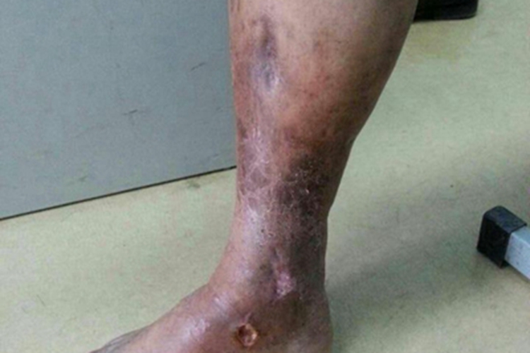 丹毒小腿皮肤发黑烂了图 丹毒小腿皮肤发黑烂了图