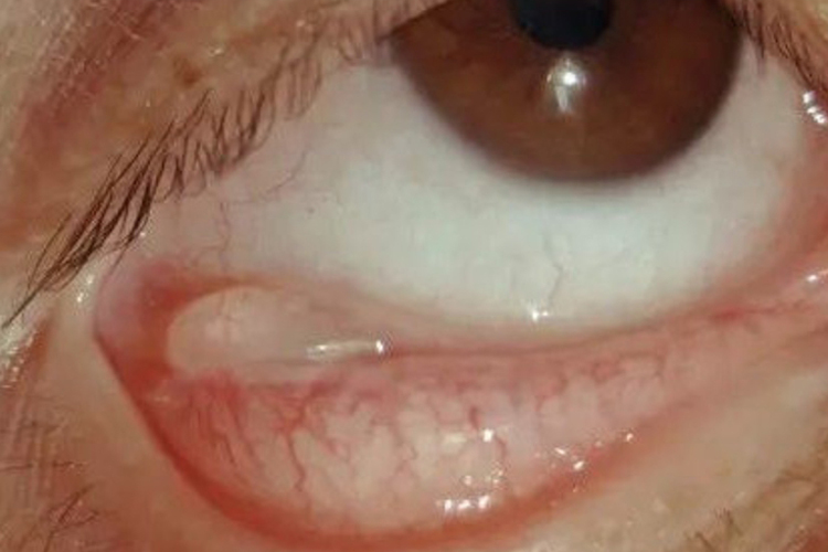 斜视术后结膜囊肿图