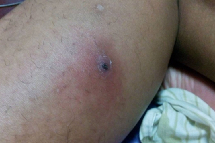 偶遇分枝杆菌感染大腿紫斑图 偶遇分枝杆菌感染大腿紫斑图