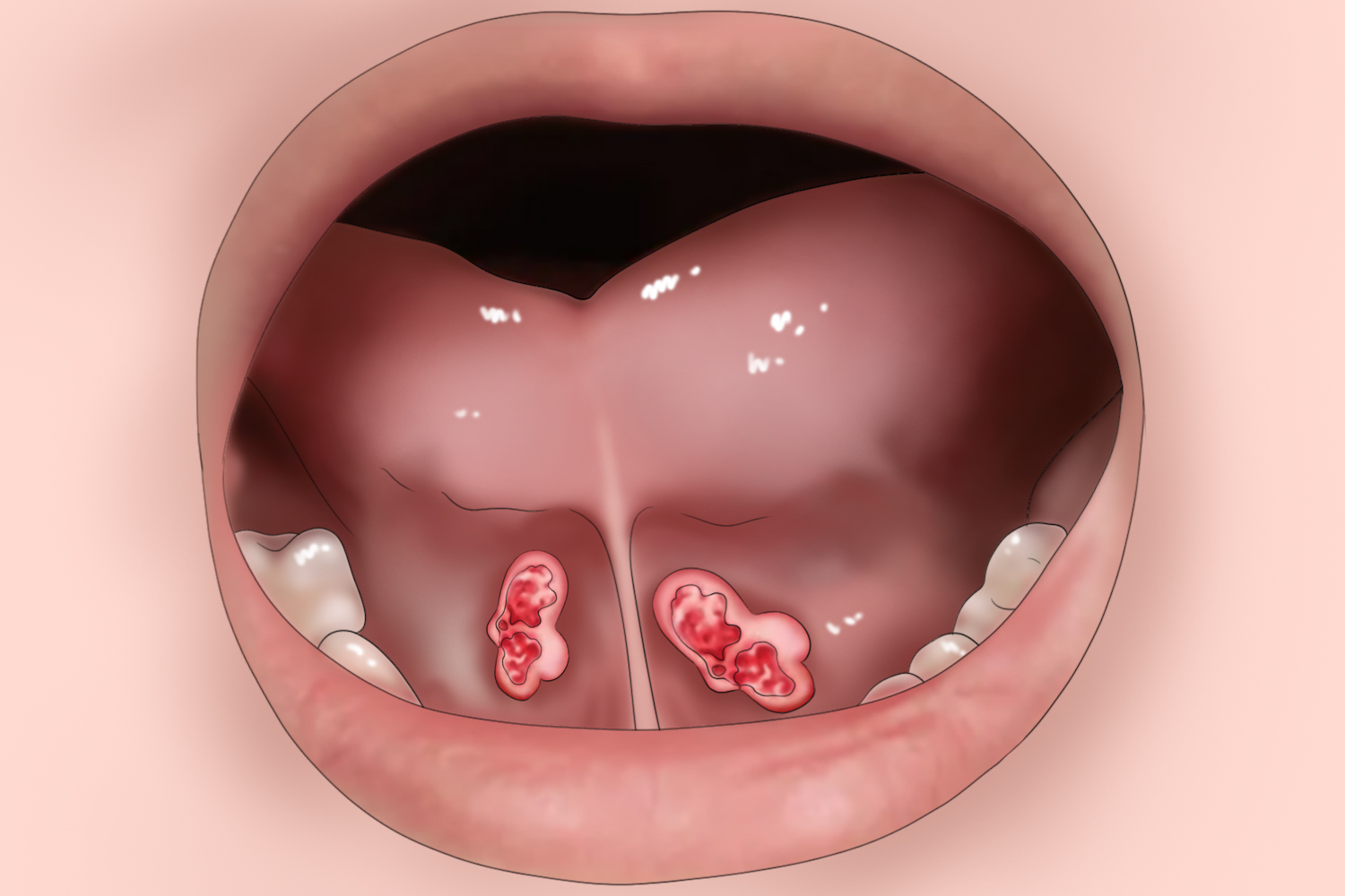口底癌位置示意图