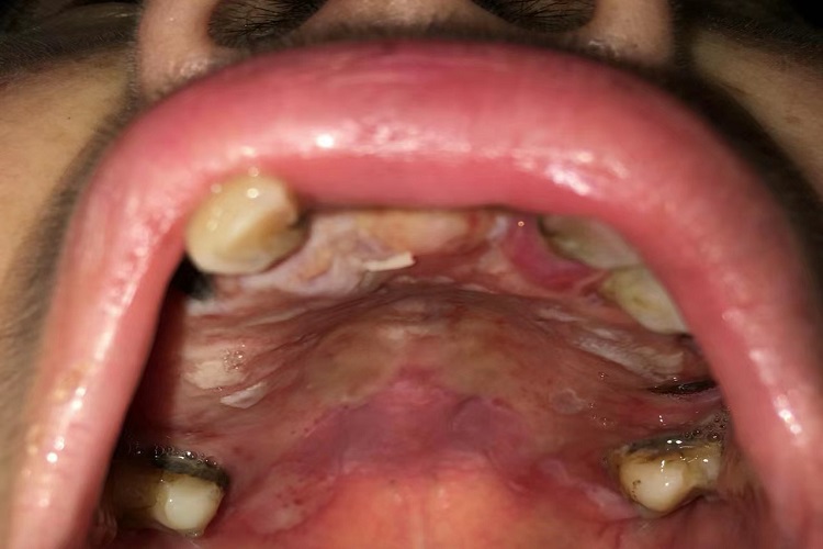 口腔黏膜烫伤发白图 口腔黏膜烫伤发白图