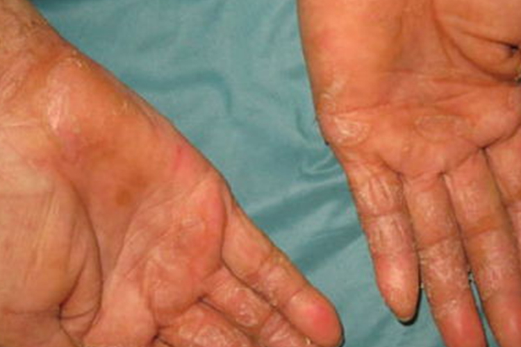 艾滋病手上脱皮图
