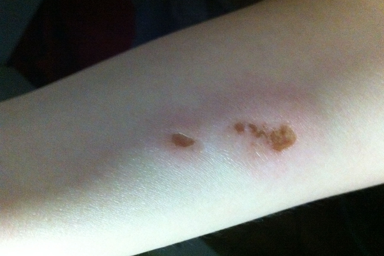 硫酸烫伤皮损深棕色图