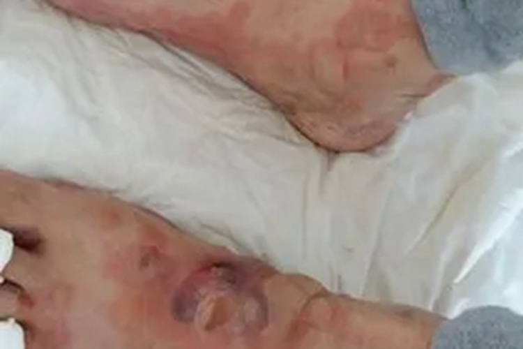 副肿瘤性天疱疮脚部症状图 副肿瘤性天疱疮脚部症状图