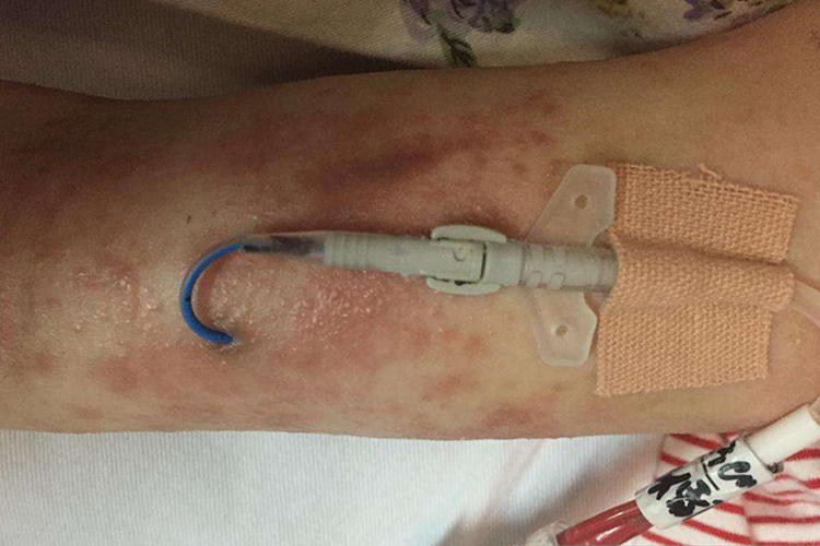 PICC置管过敏红疹图