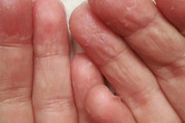 剥脱性角质松解症手指尖脱屑图 剥脱性角质松解症手指尖脱屑图