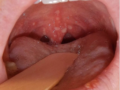 咽峡炎的早期图片图片