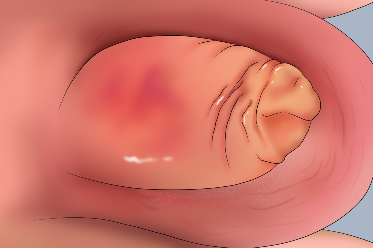 小儿包皮龟头炎图