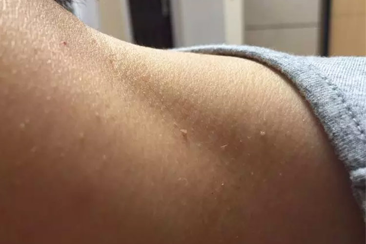 丝状型肉赘图