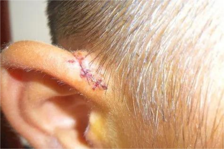 儿童耳朵缝针后血痂图 儿童耳朵缝针后血痂图