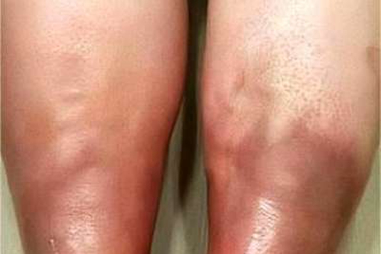 急性期硬化性脂膜炎小腿症状图 急性期硬化性脂膜炎小腿症状图