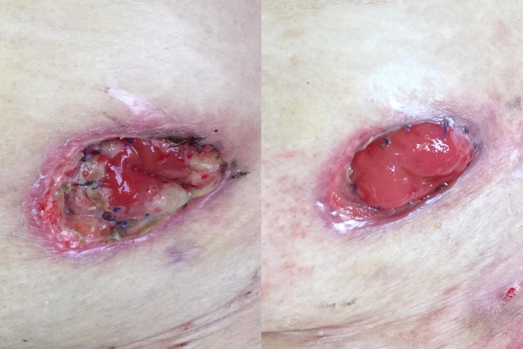 造口黏膜肉芽肿图