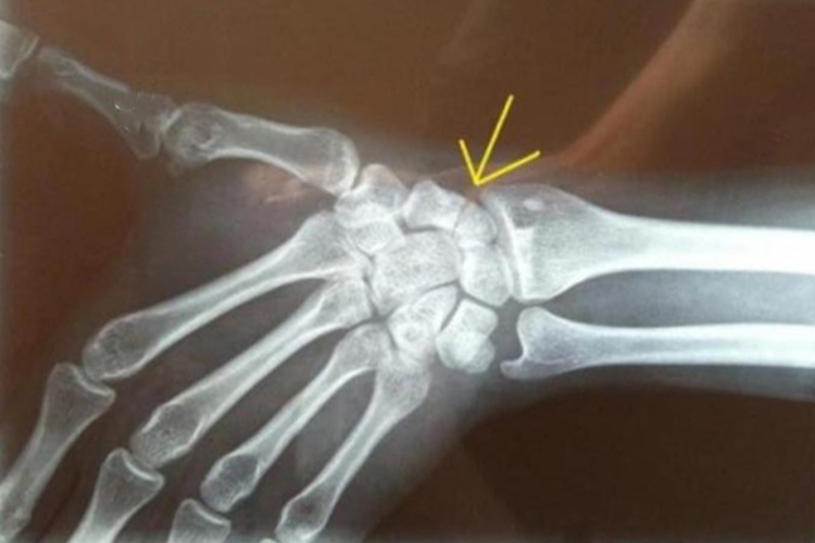 手腕骨折X线图