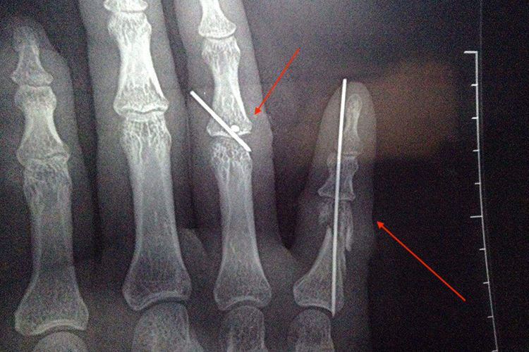 指骨骨折克氏针示意图