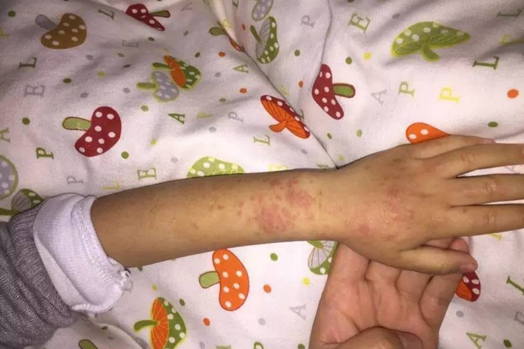 过敏性紫癜手上有红色瘀血图