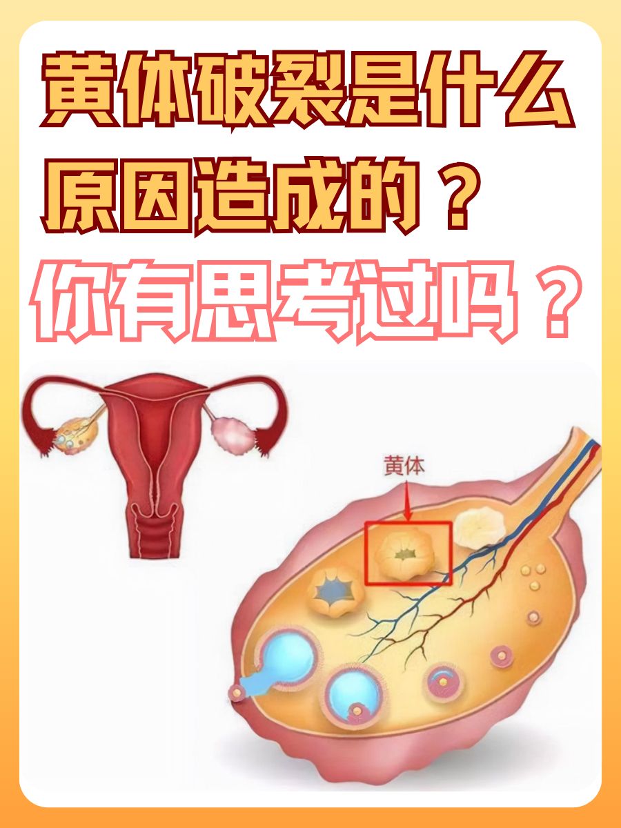 黄体破裂是什么原因造成的？你有思考过吗