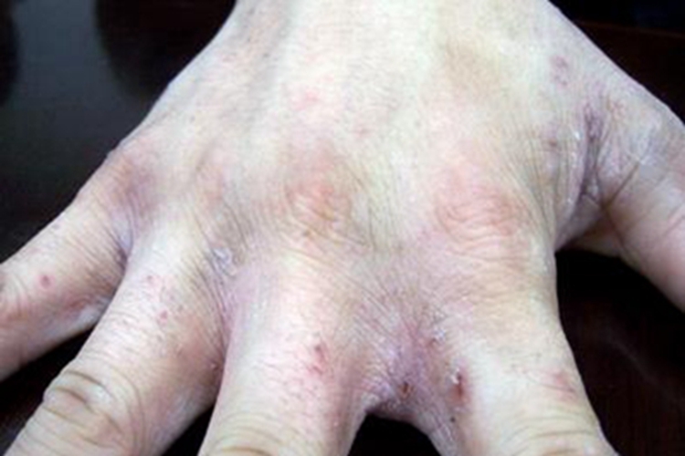 冬季瘙痒症手背干燥结痂图