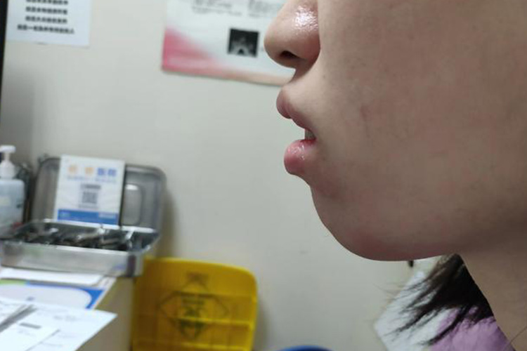 腺样体面容侧面观