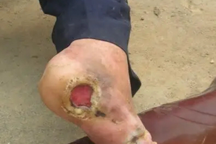 瘤型麻风溃疡图