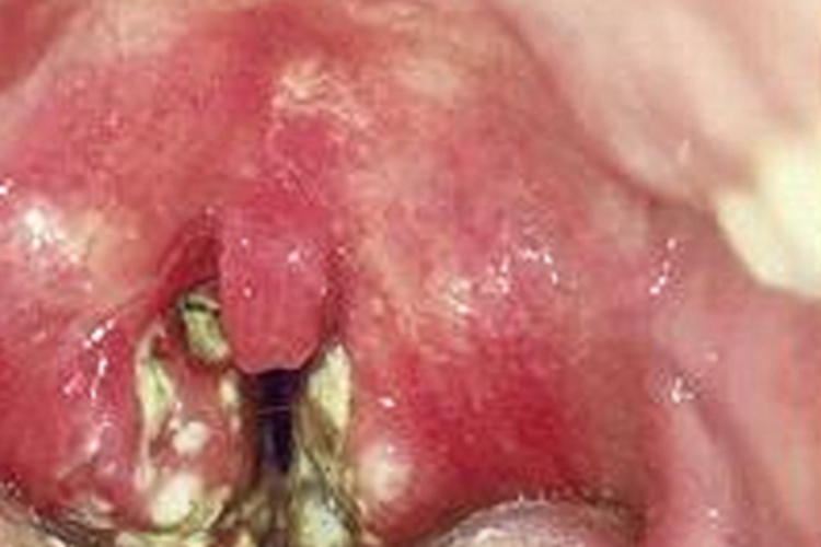 脓毒型猩红热红肿图 脓毒型猩红热红肿图