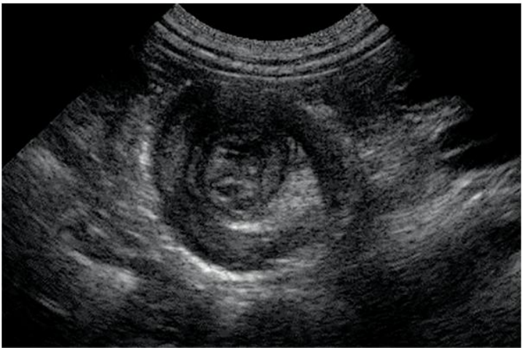 肠套叠X线图 肠套叠X线图