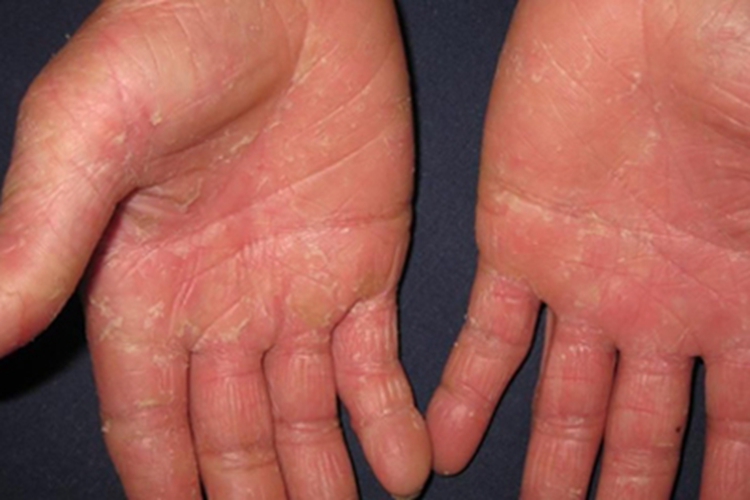 可变性红斑角化症手掌皮肤增厚图