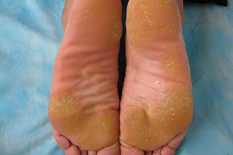 掌跖点状角化脚底皮肤发黄图 掌跖点状角化脚底皮肤发黄图
