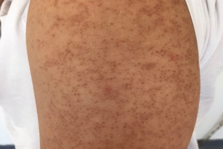 寻常型鱼鳞病黑点图 寻常型鱼鳞病黑点图