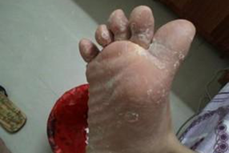 小孩糜烂型足癣图