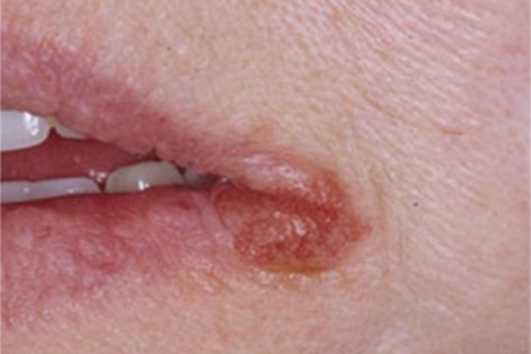 创伤性口角唇炎症状图
