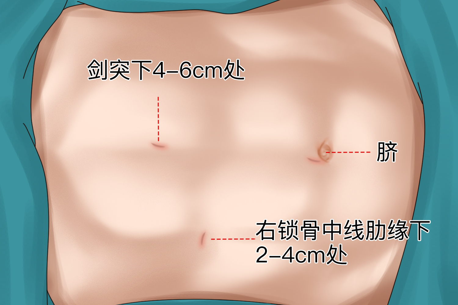 胆结石手术打三孔位置图 胆结石手术打三孔位置图