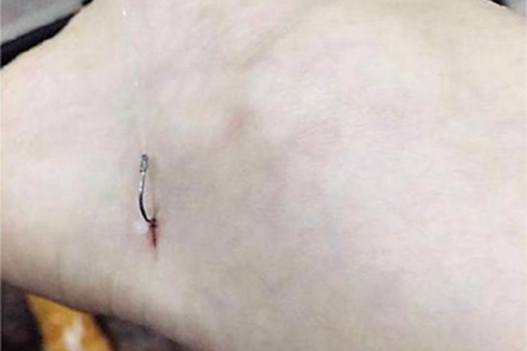 戳伤脚踝一道划痕图