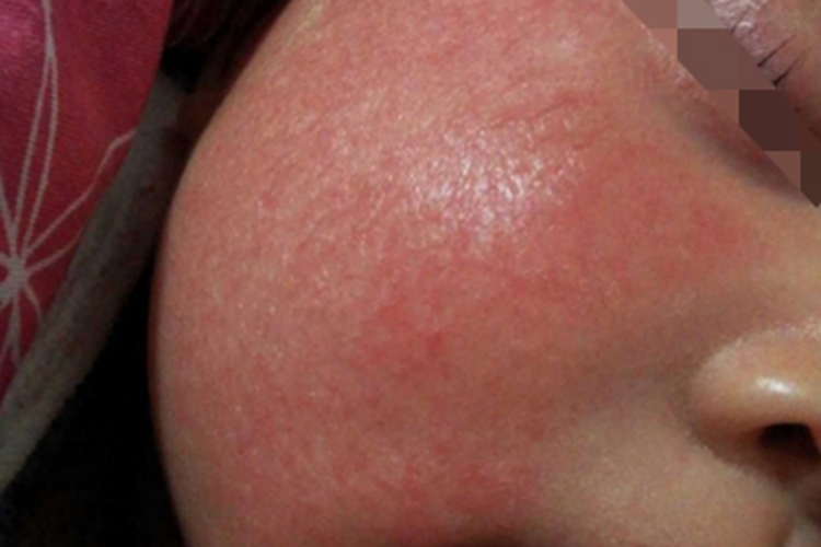 奶癣脸上很干皮肤发红紧绷图 奶癣脸上很干皮肤发红紧绷图