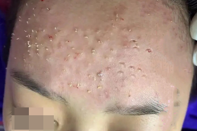 粉刺栓挤出图 粉刺栓挤出图