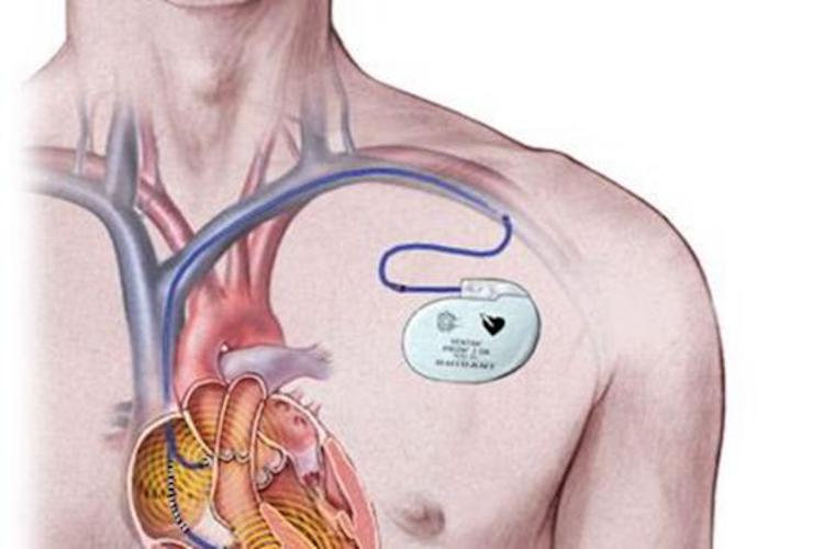 心脏金属起搏器图