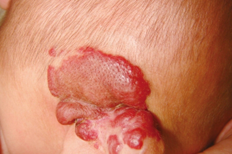 血管瘤耳部大红疙瘩图 血管瘤耳部大红疙瘩图