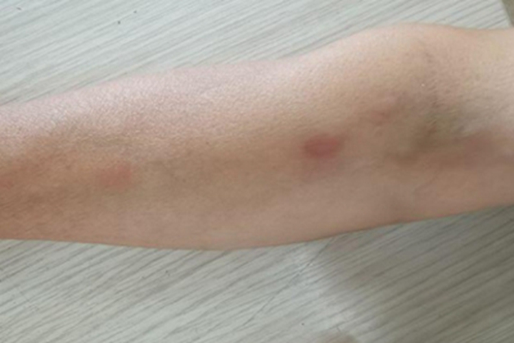 儿童结节性多动脉炎结节图