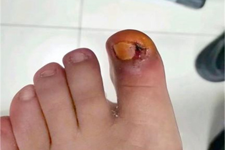 急性化脓性甲沟炎红肿图