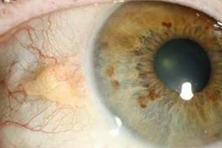 睑裂斑眼球血丝斑图