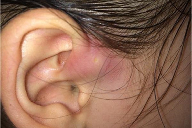 先天性耳前瘘管耳部大包图
