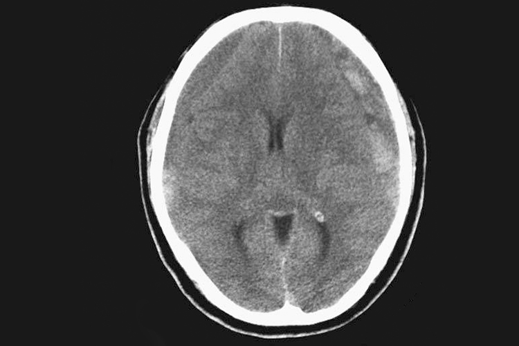 亚急性硬膜下血肿ct图