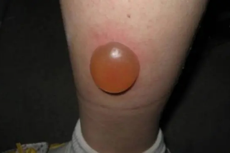 深静脉血栓形成张力性水疱图 深静脉血栓形成张力性水疱图