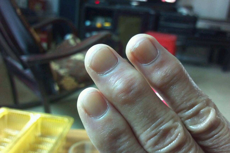 骨关节炎手指头粗大图