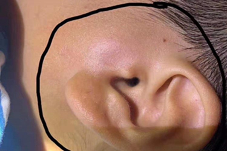 儿童复发性腮腺炎耳前症状图 儿童复发性腮腺炎耳前症状图