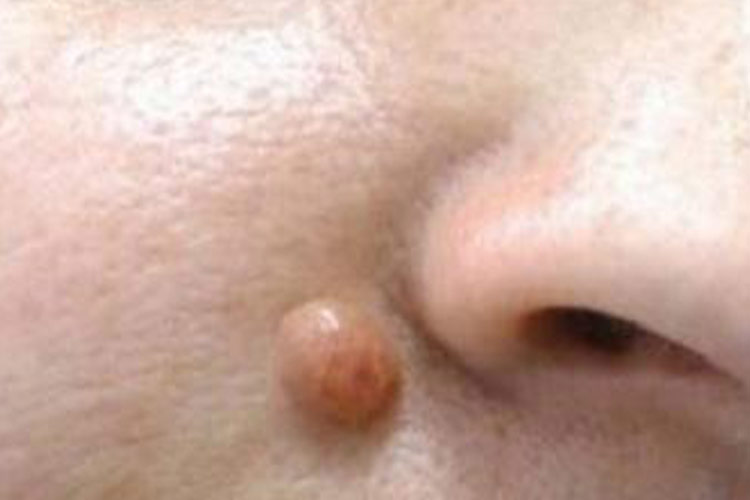 面部皮肤纤维瘤图