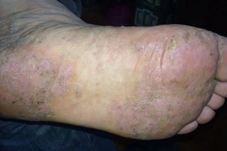 水疱型足癣脚底红斑图